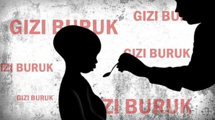 Penyebab dan Ciri Penyakit Busung Lapar Menurut dr. Roro Rukmi Windi ...